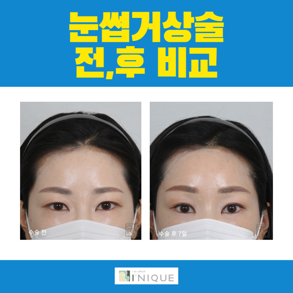 눈썹수술로 더 또렷하고 시원한 인상을 만드세요! 관련 이미지 6