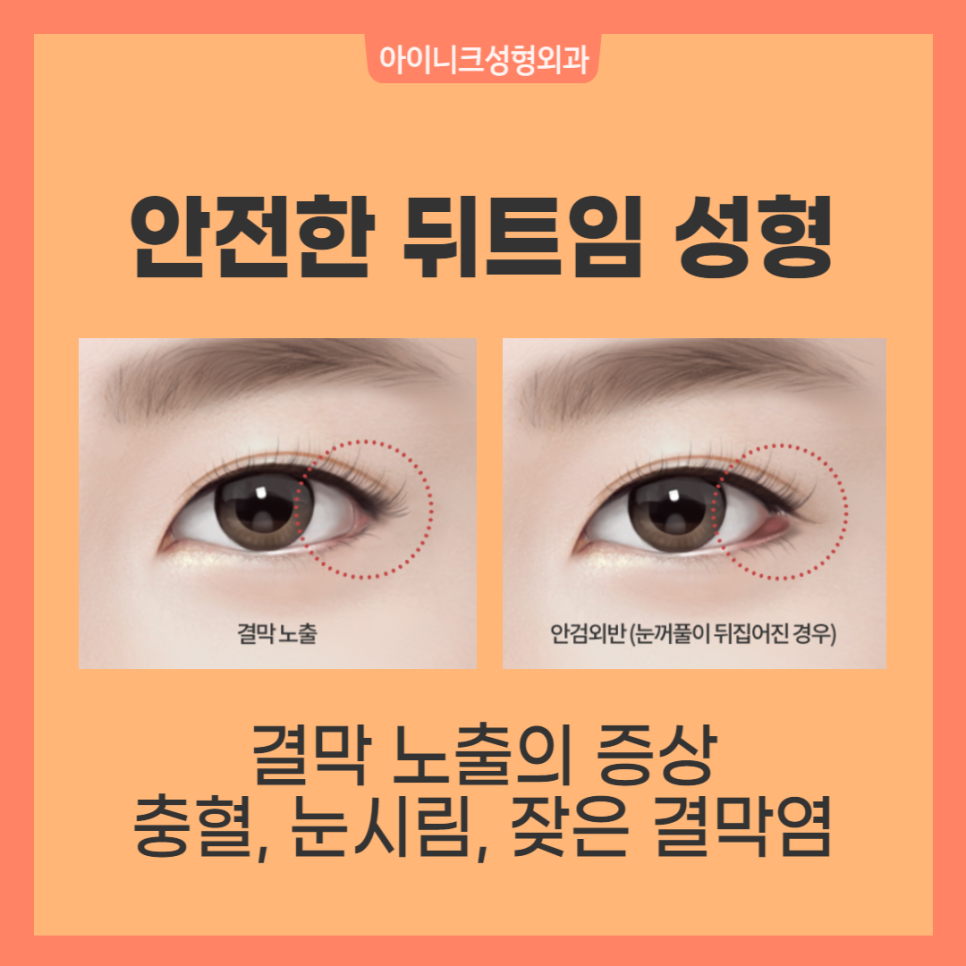 뒤트임성형 자연스러운 아름다움을 위해 관련 이미지 2