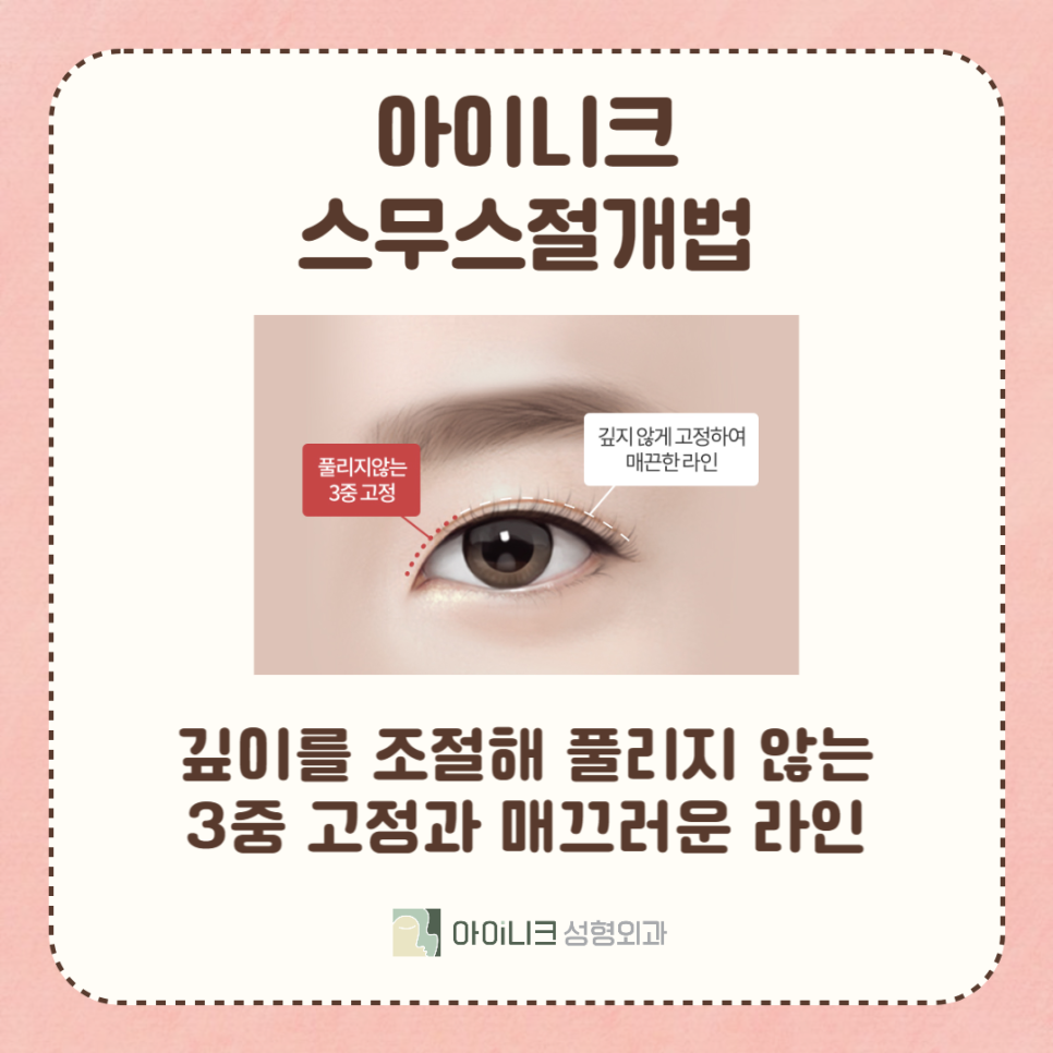 여자쌍꺼풀수술 내 눈매에 딱 맞게! 관련 이미지 3