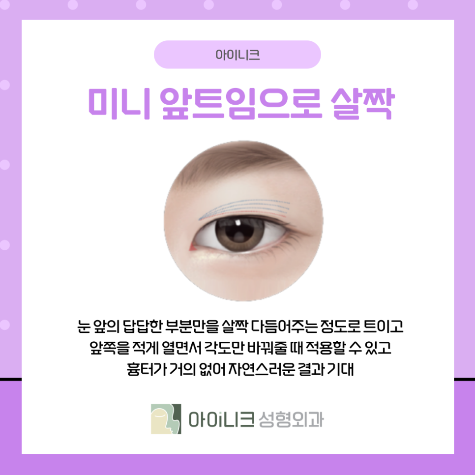 앞트임눈매교정 과하지 않고 자연스럽게 관련 이미지 11
