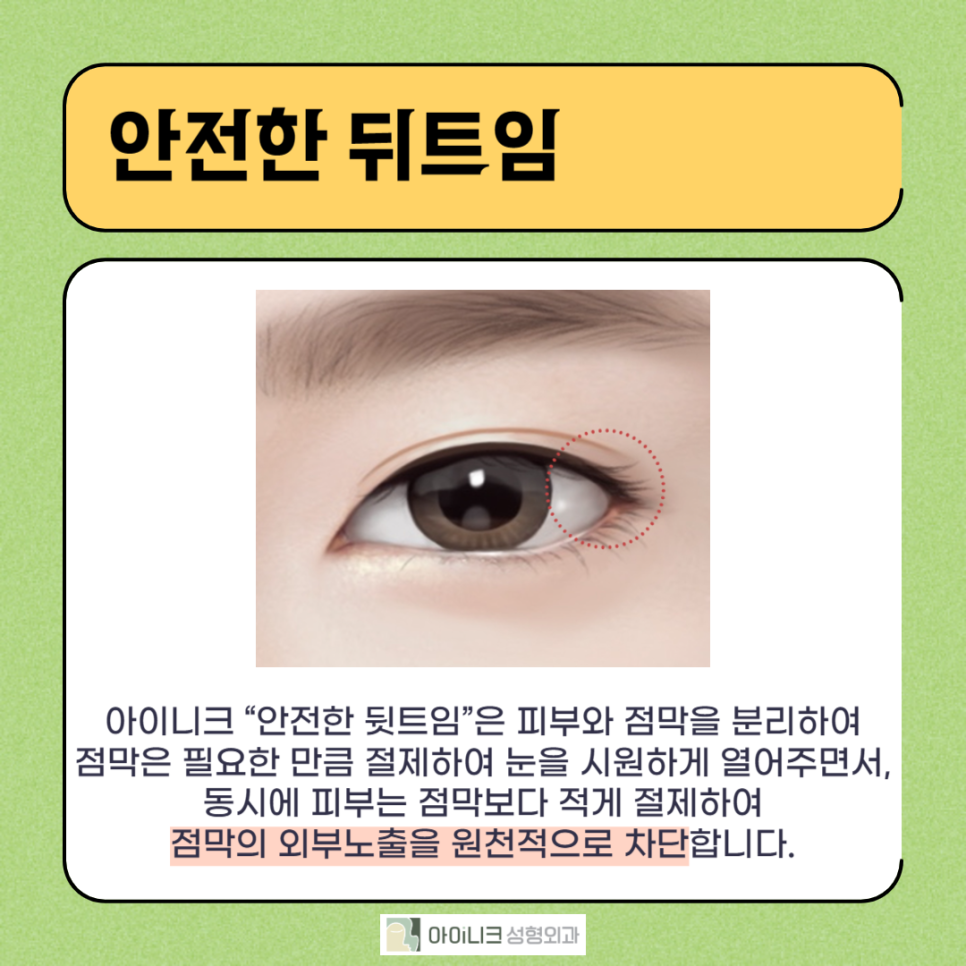 눈꼬리내리는수술로 강아지상 만들기 관련 이미지 4