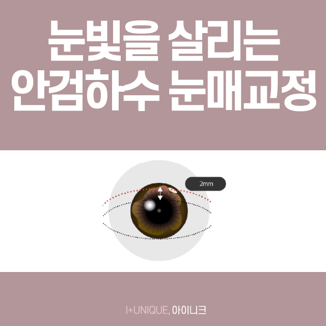남녀노소 가능한 눈매교정술 그리고 가격까지 한 번에 알아보자! 관련 이미지 2