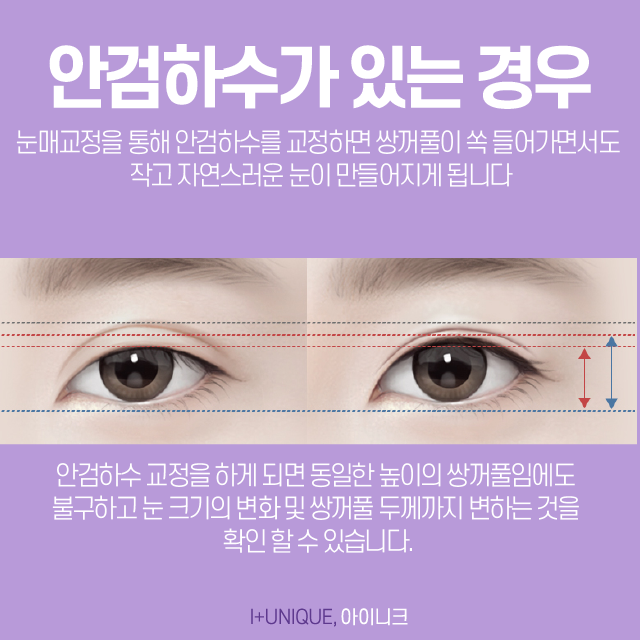쌍꺼풀제수술잘하는곳을 찾는다면 아이니크만한 곳이 없죠 관련 이미지 5