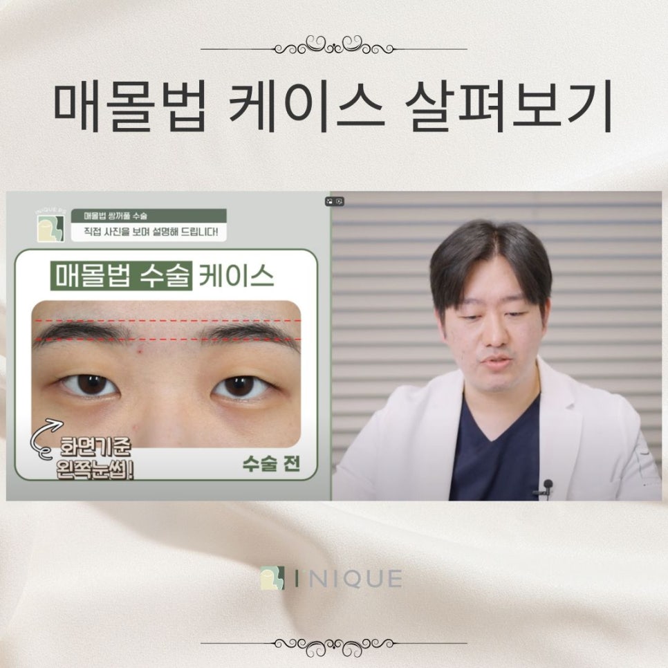 여자눈매몰법 고려해야하는 점 관련 이미지 1