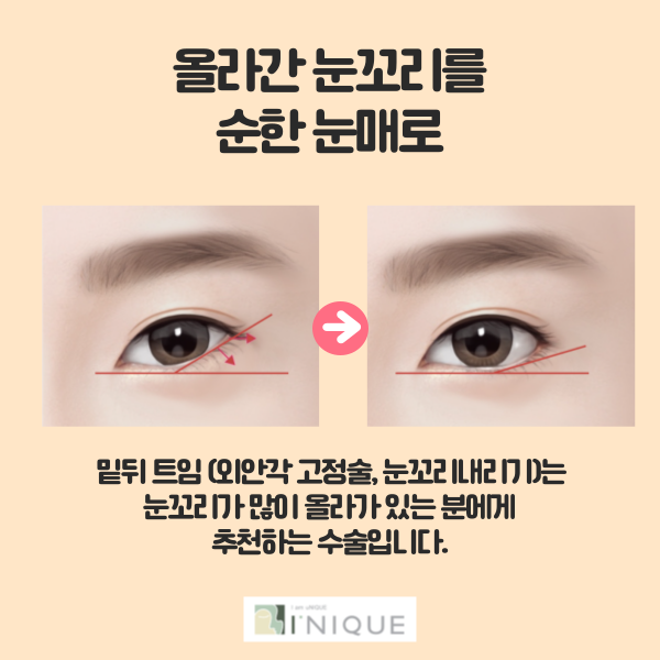 Eyelid Corner Surgery: Natural Results Are Essential! image 5