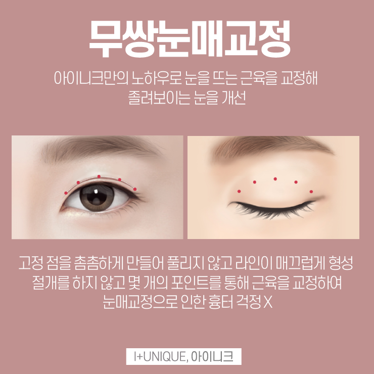 남자눈성형추천을 받고 싶다면 어떻게 해야할까 관련 이미지 4