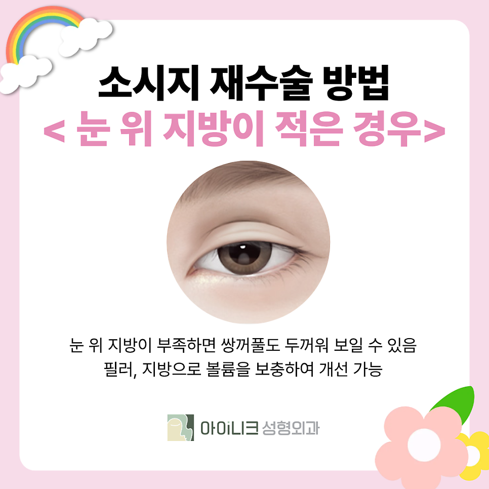 Revision Surgery for “Sausage Eyes”: How Should Thick Double-Eyelid Folds Be Corrected? image 5