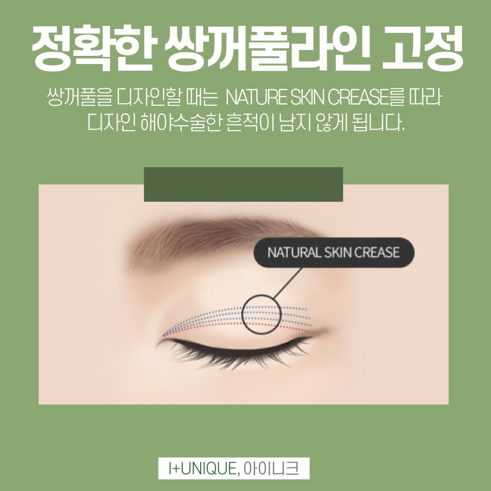 눈재수술유명한곳 어렵게 찾지말고 바로 아이니크성형외과에서 관련 이미지 3