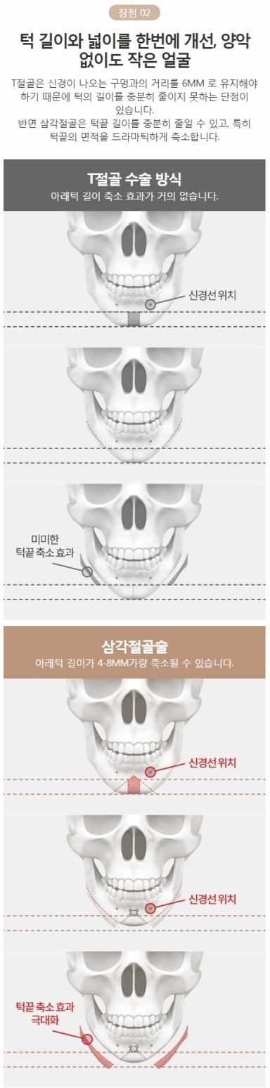 턱끝절골술 양악 없이도 완벽한 얼굴라인! 관련 이미지 5