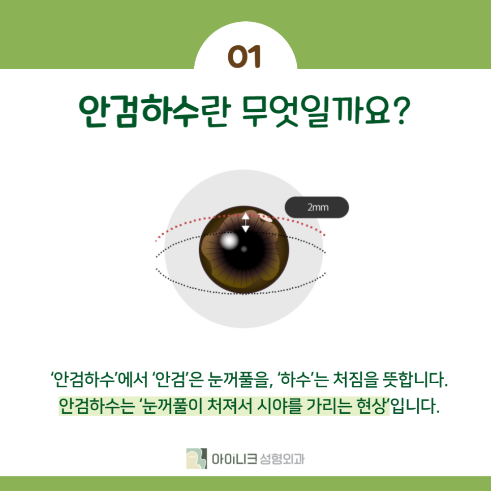 눈매교정 쌍수 차이는 무엇일까요? 관련 이미지 2