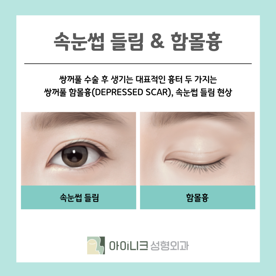 서울성형외과 속눈썹 들림 흉터가 생겼을 때 관련 이미지 6