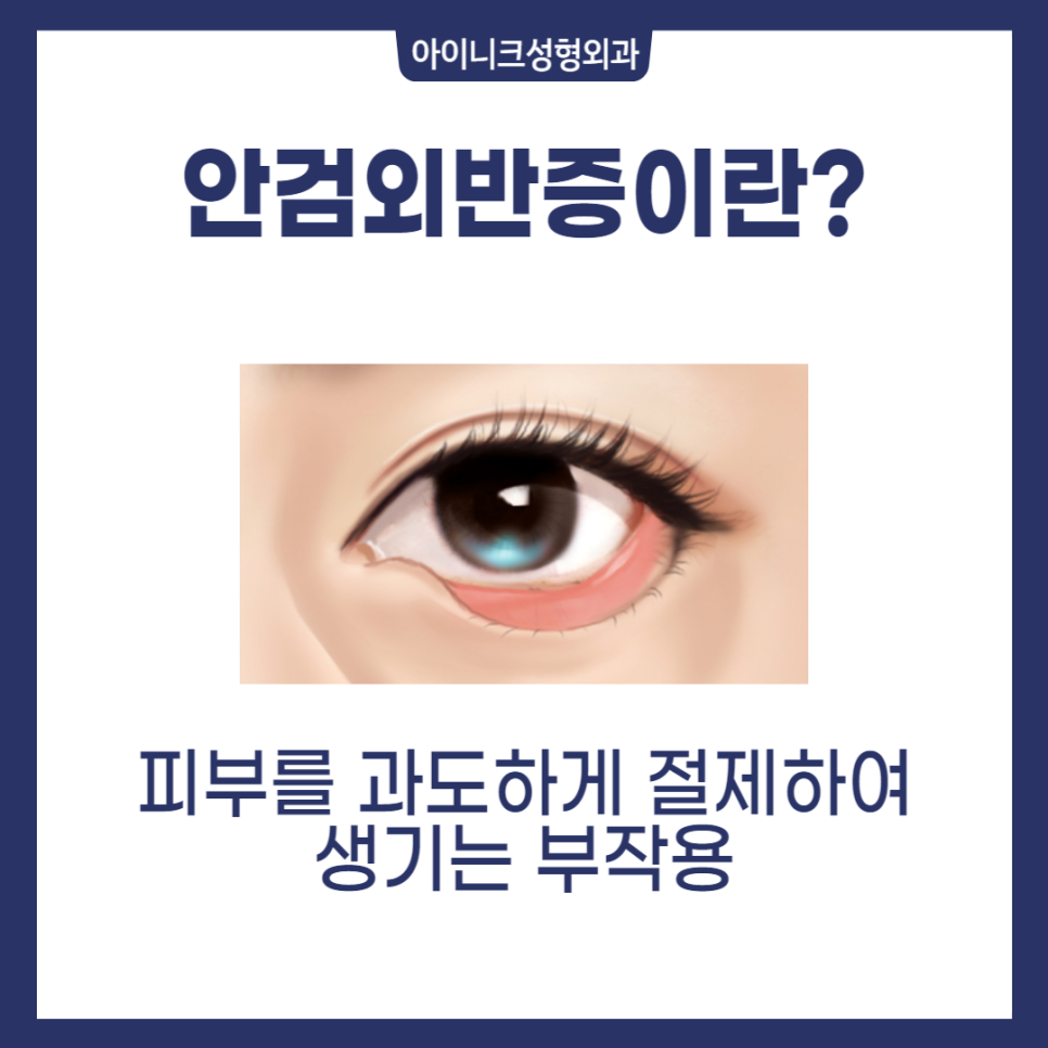40대중년눈성형, 많이 하나요? 관련 이미지 4