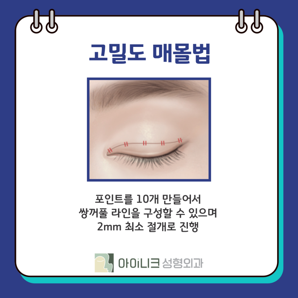 압구정눈성형외과 쌍꺼풀 수술 종류 방법? 관련 이미지 8
