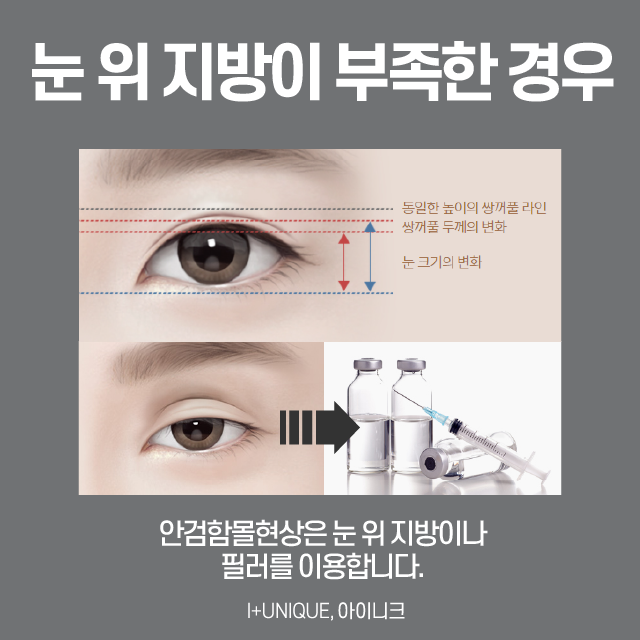 Sausage Double-Eyelid Correction: There Is No Second Failure! image 5