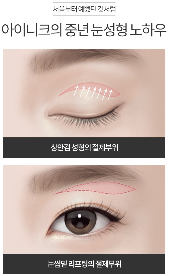 상안검성형술로 다시 20대의 눈매! 관련 이미지 3