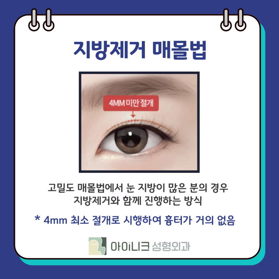 압구정눈성형외과 쌍꺼풀 수술 종류 방법? 관련 이미지 10