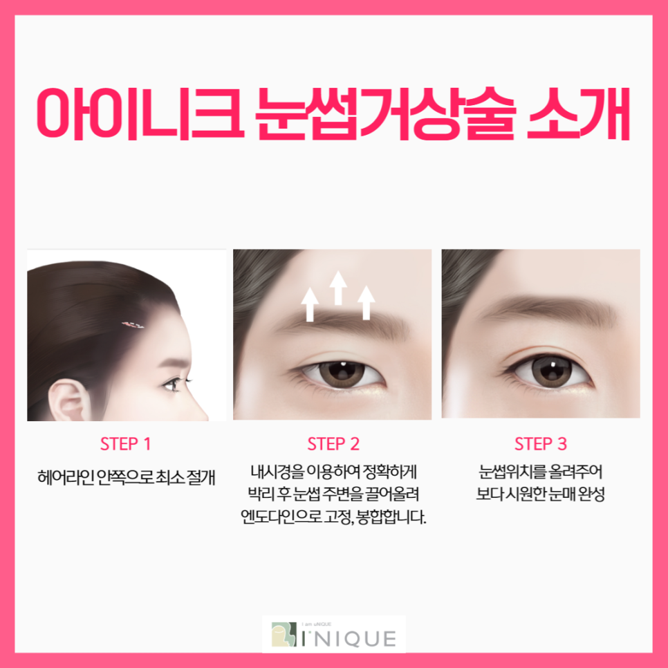 엔도타인이마거상, 흉터는 적게 리프팅은 확실하게! 관련 이미지 6