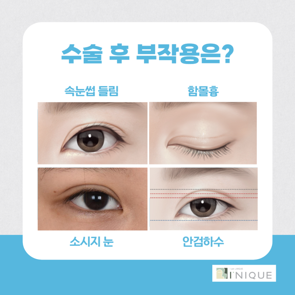 눈성형재수술, 마지막이 되려면? 관련 이미지 2