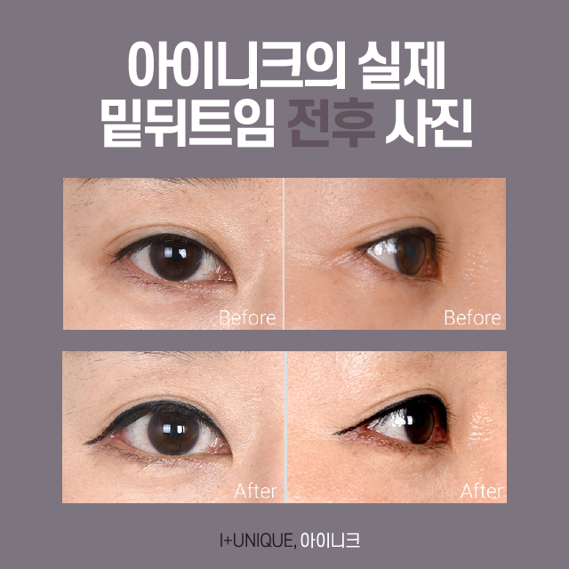 뒤밑트임 성형 성공하는 방법은? 관련 이미지 5