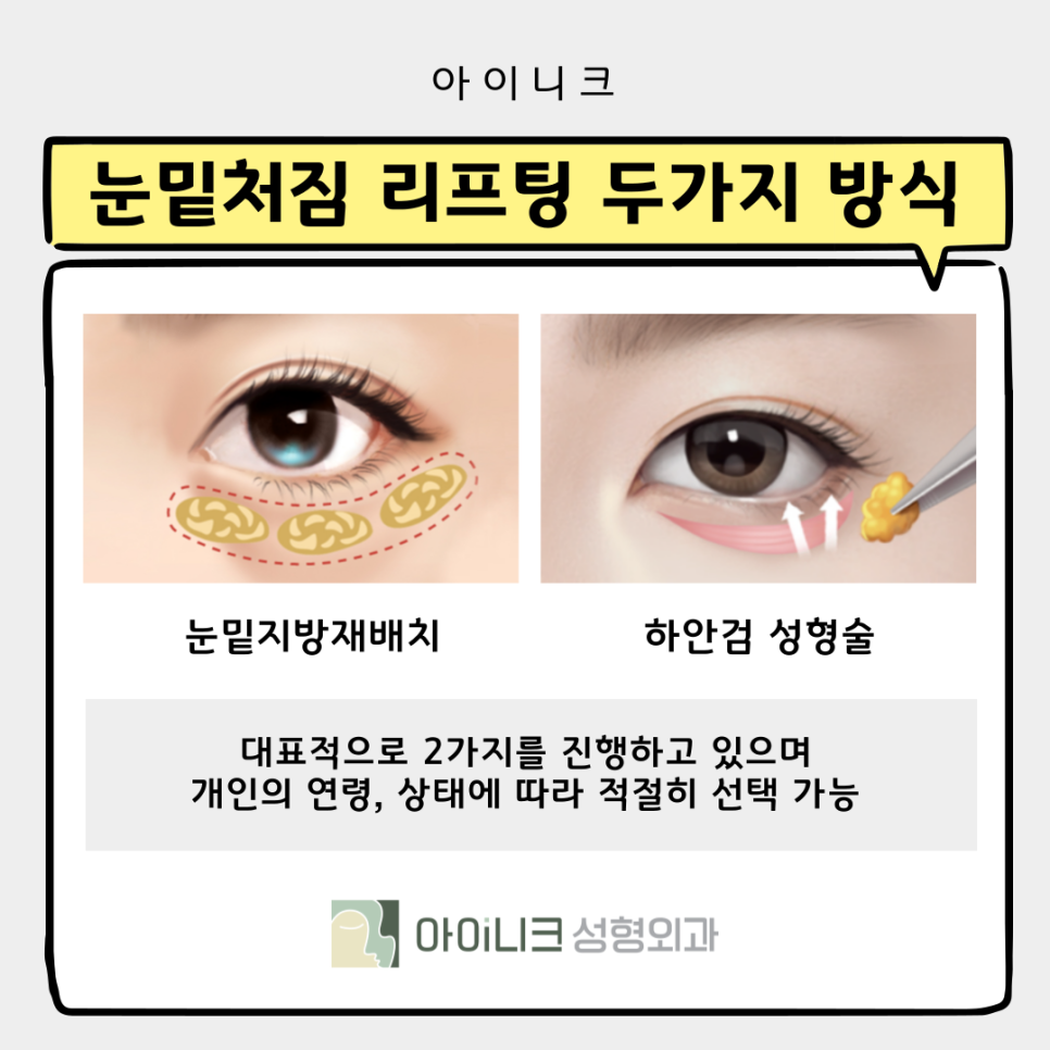 Two Ways to Look 10 Years Younger with Under-Eye Sagging Lifting image 5