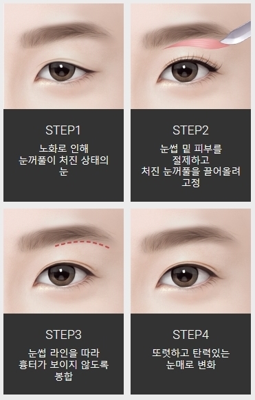 중년쌍꺼풀수술 눈썹밑 리프팅으로 깨끗하게 관련 이미지 3