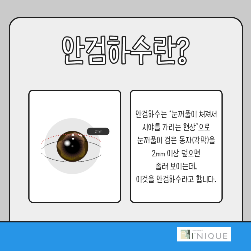 처진눈성형, 또렷한 눈매를 위한 가장 확실한 방법 관련 이미지 2