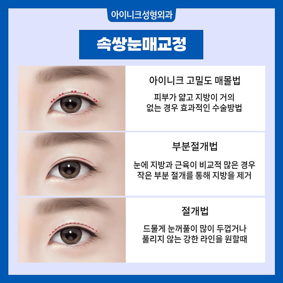 남자쌍꺼풀수술 부드럽고 자연스럽게 관련 이미지 3