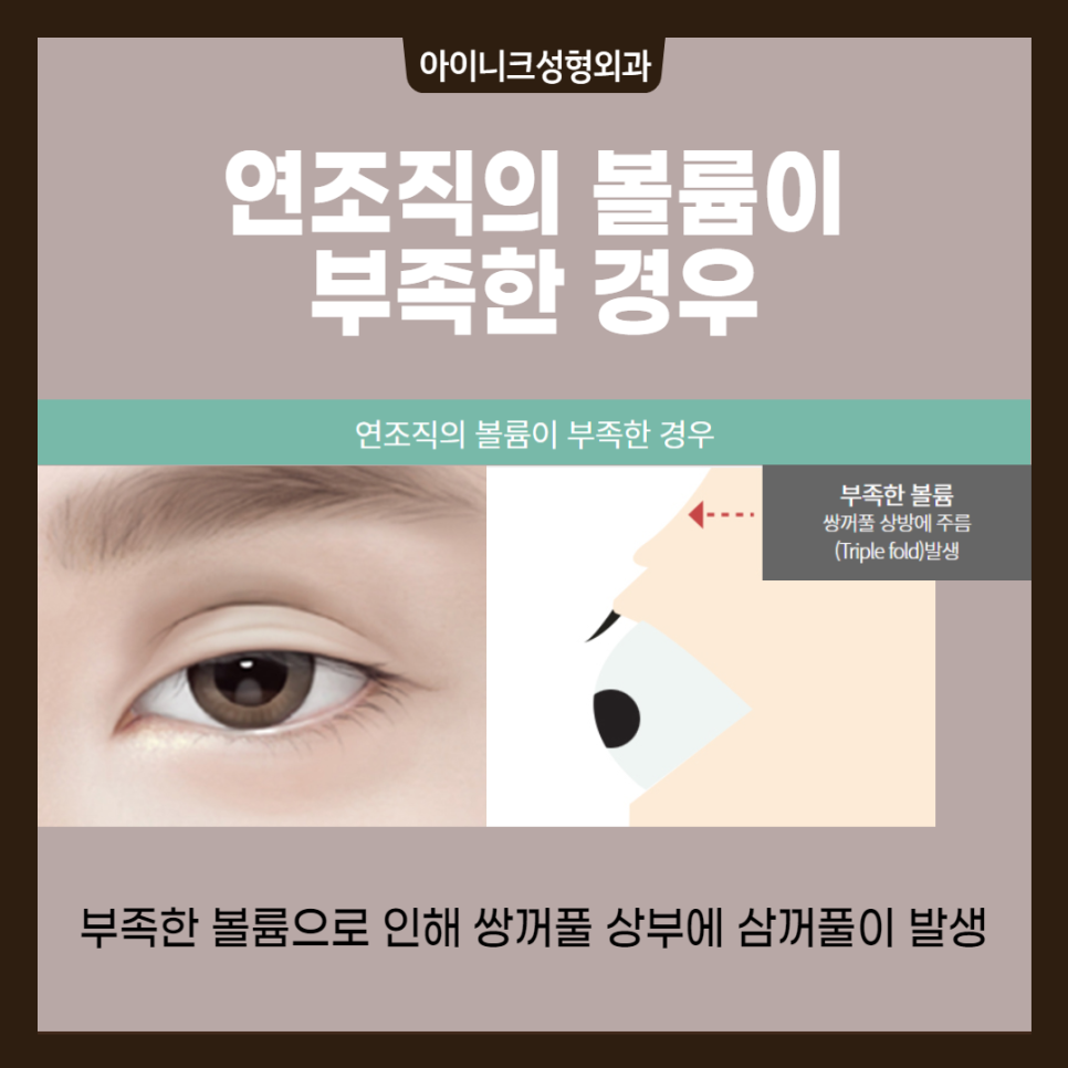 겹쌍꺼풀 해결방법, 원인에 따른 플랜이 필요해요! 관련 이미지 4