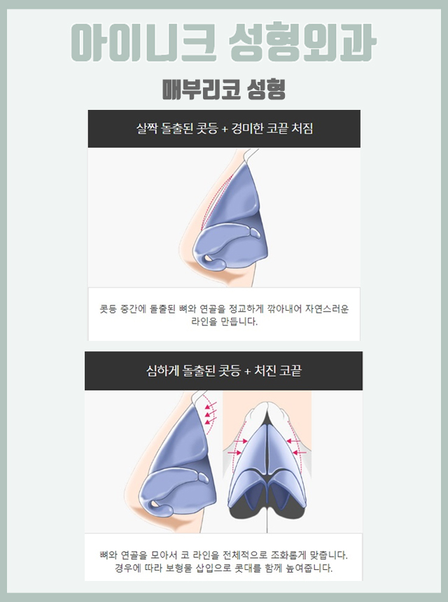 화살코성형후기 정면, 측면 모두 완벽하게! 관련 이미지 6