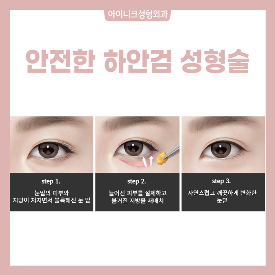 동안눈성형, 제대로 하고 싶다면 관련 이미지 5