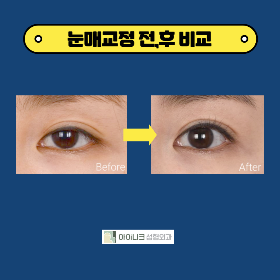 눈매교정잘하는곳에서 졸린 눈 해결 후기 관련 이미지 6