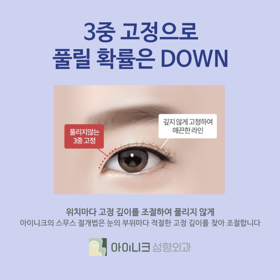 강남성형외과 아이니크의 자연스럽고 예쁜 쌍꺼풀 관련 이미지 6