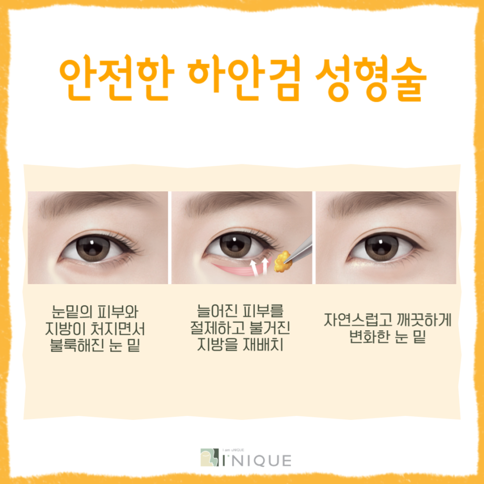 Have You Heard About Middle-Age Eye Rejuvenation Surgery? image 5