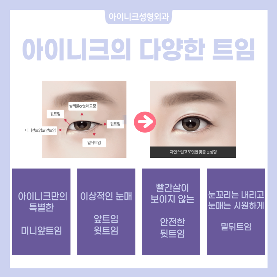 눈트임수술종류 다양하게 알아보고 선택하자! 관련 이미지 2