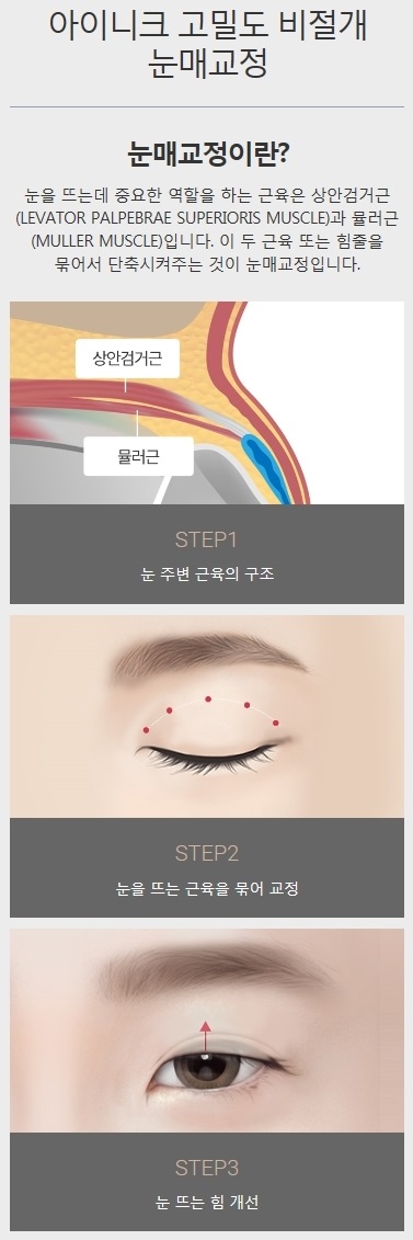 비절개눈매교정술 주의할 건 없을까? 관련 이미지 3