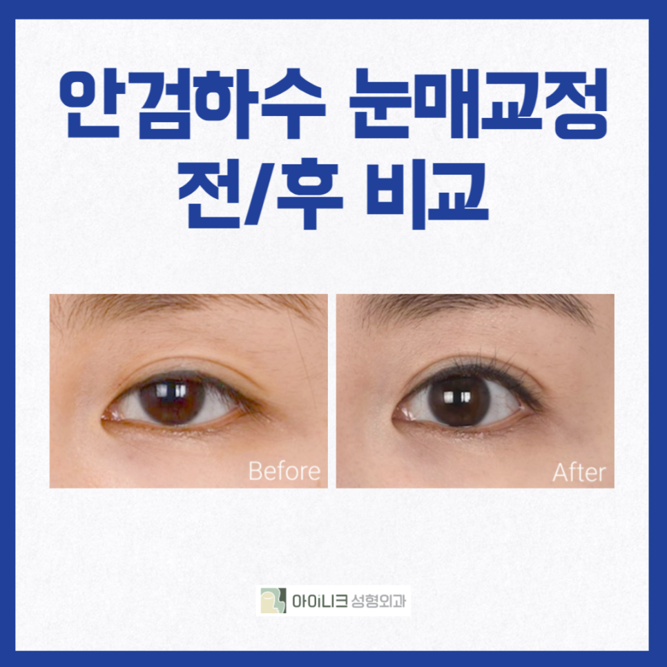 안검하수잘하는곳 찾고 있나요? 관련 이미지 5