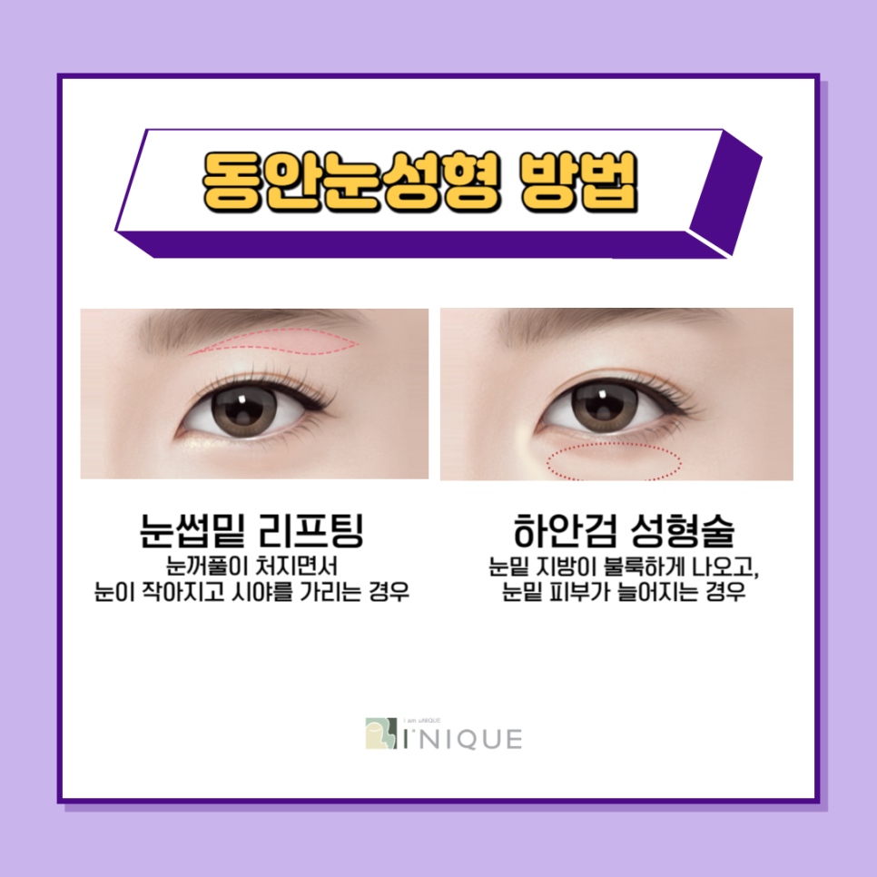 동안눈성형으로 자신감 회복 관련 이미지 2
