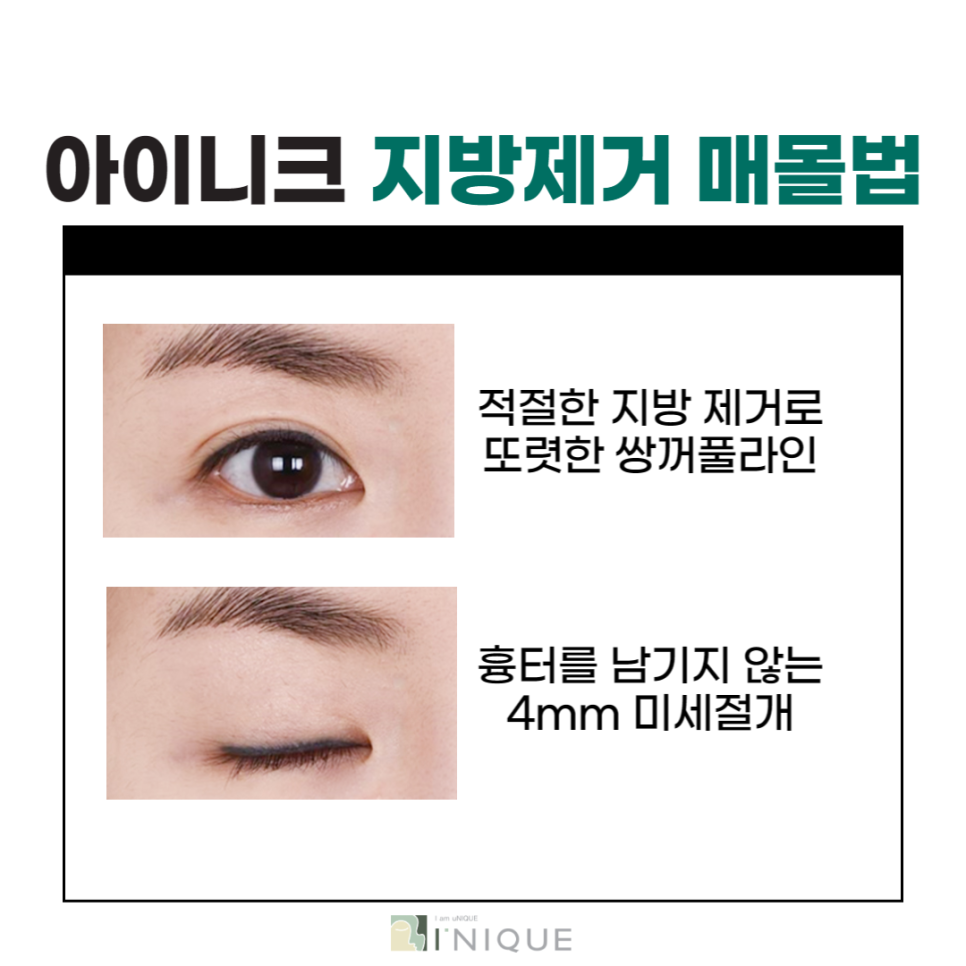 If You Want a Clear Change Before and After Double Eyelid Surgery image 6