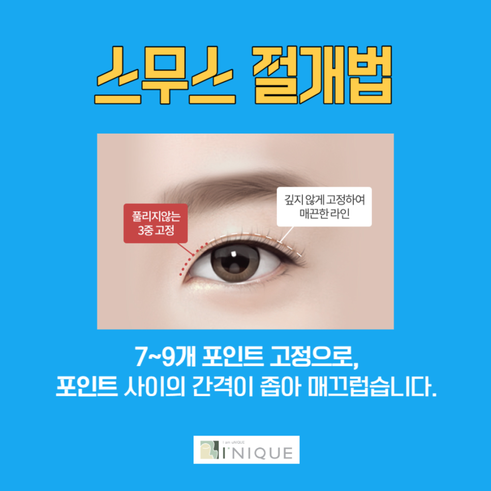 쌍꺼풀절개수술 잘하는 곳 관련 이미지 4