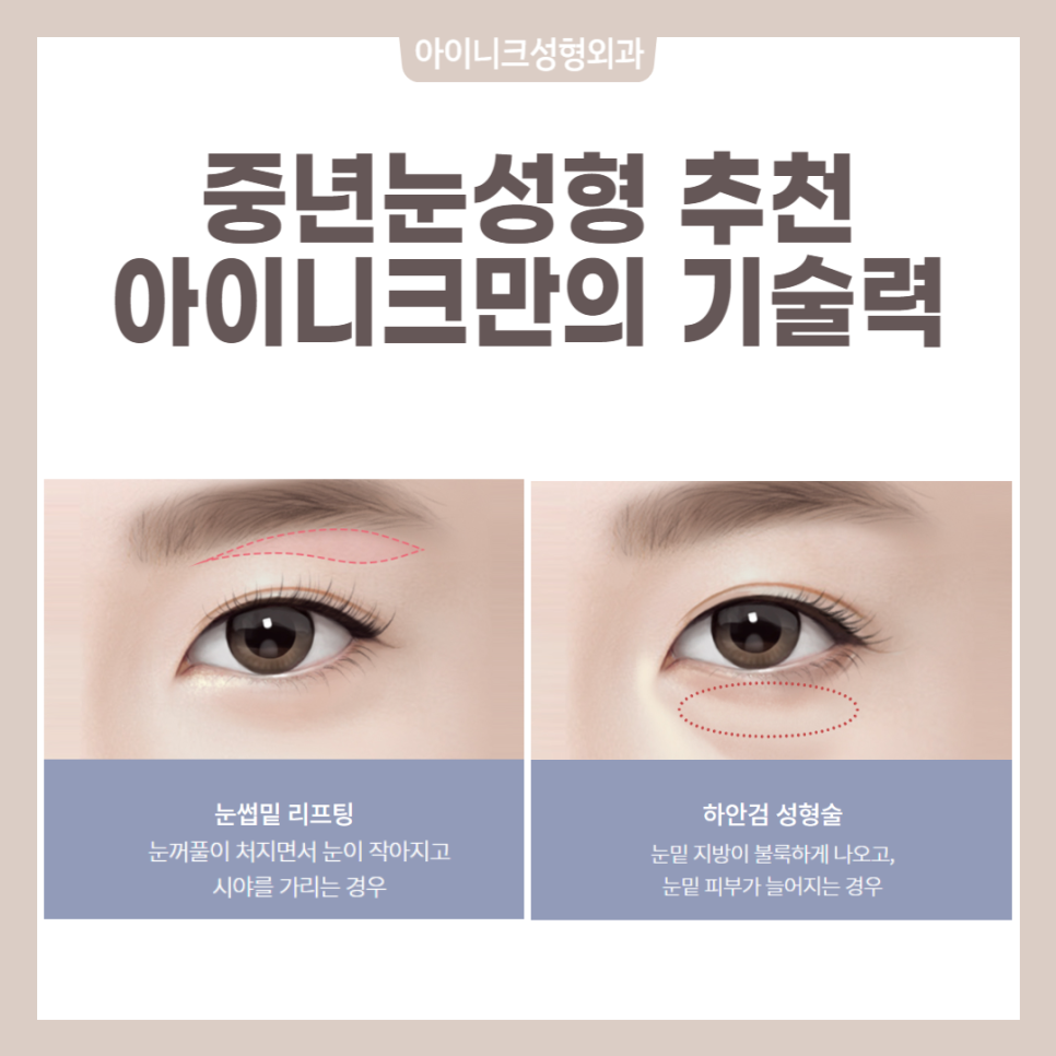 How Can You Get Recommended Midlife Eye Surgery Naturally Without Side Effects? image 3