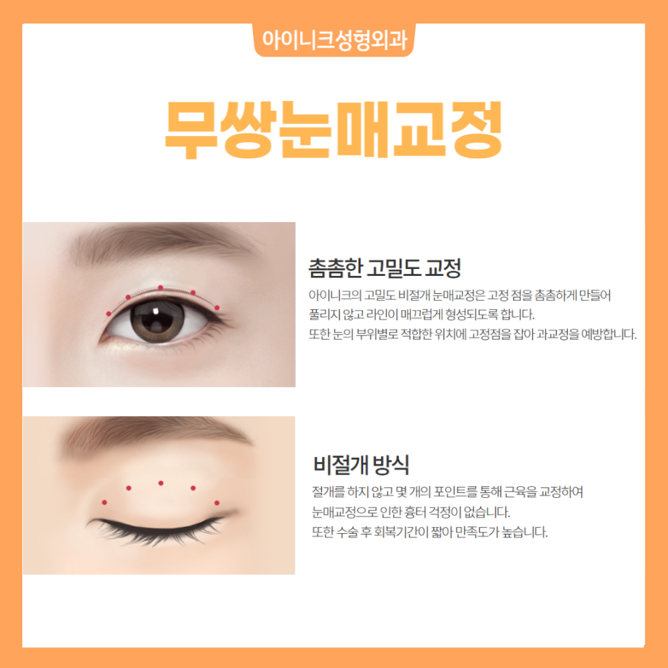 남자눈성형 한지 모를 정도의 자연스러움 관련 이미지 4