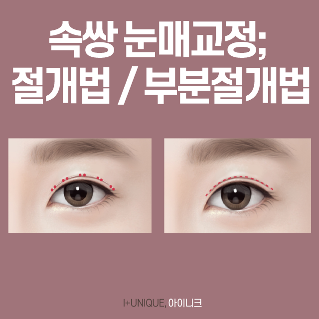 남자 눈 성형 인아웃라인 수술부터 눈매교정까지 관련 이미지 4