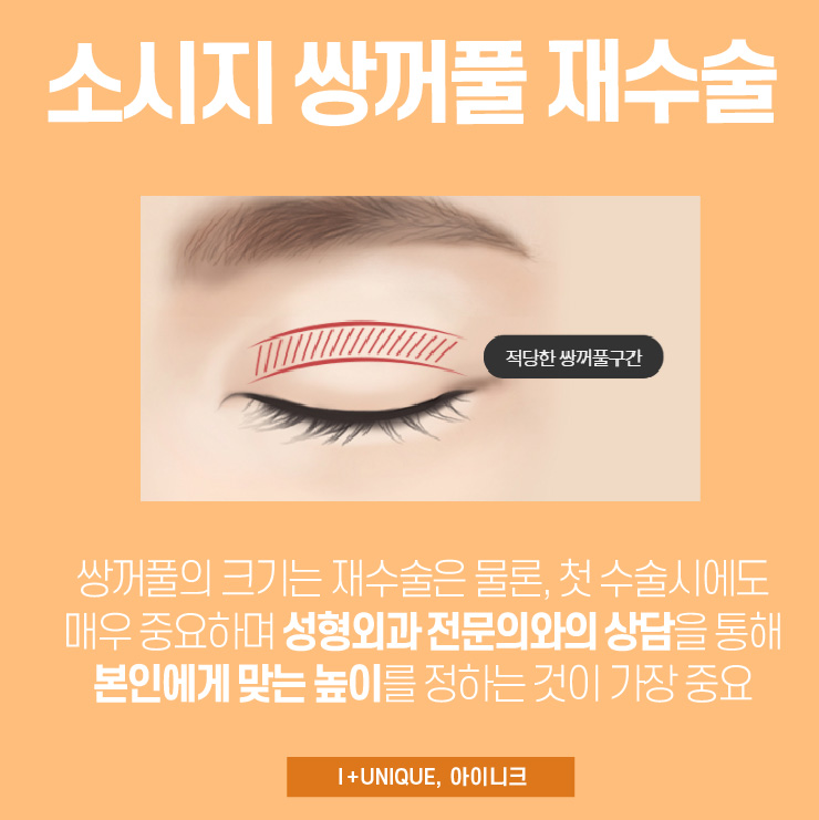 쌍꺼풀라인재수술 병원을 찾는다면 아이니크성형외과에서 신중하게 관련 이미지 4