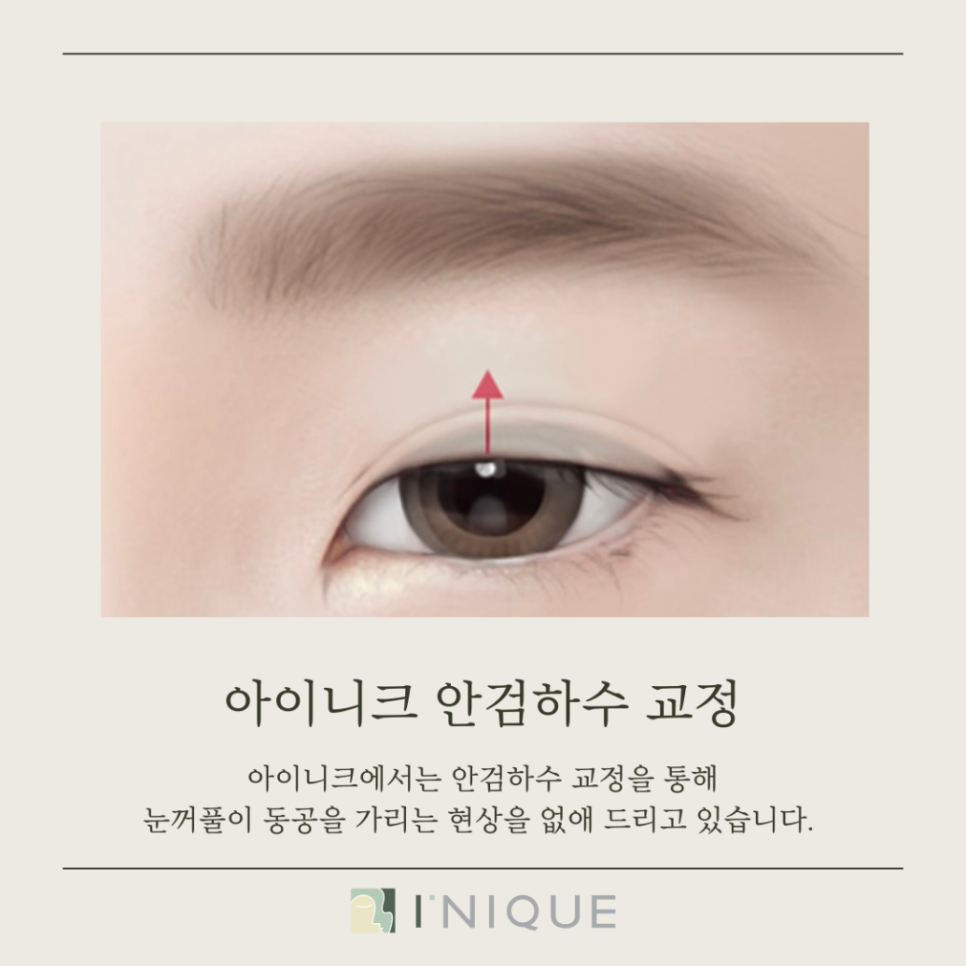 안검하수병원추천, 무엇을 고려해야 할까요? 관련 이미지 3