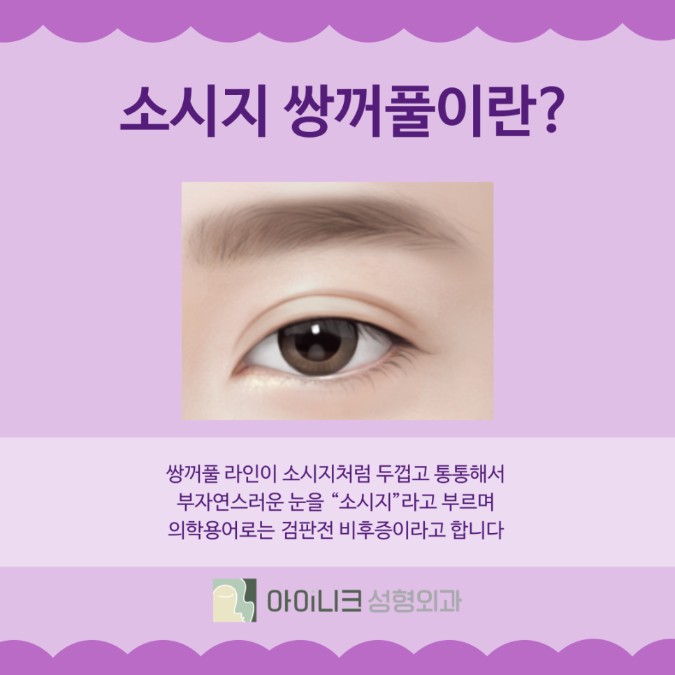 소시지쌍꺼풀 원인과 개선 방법 관련 이미지 3