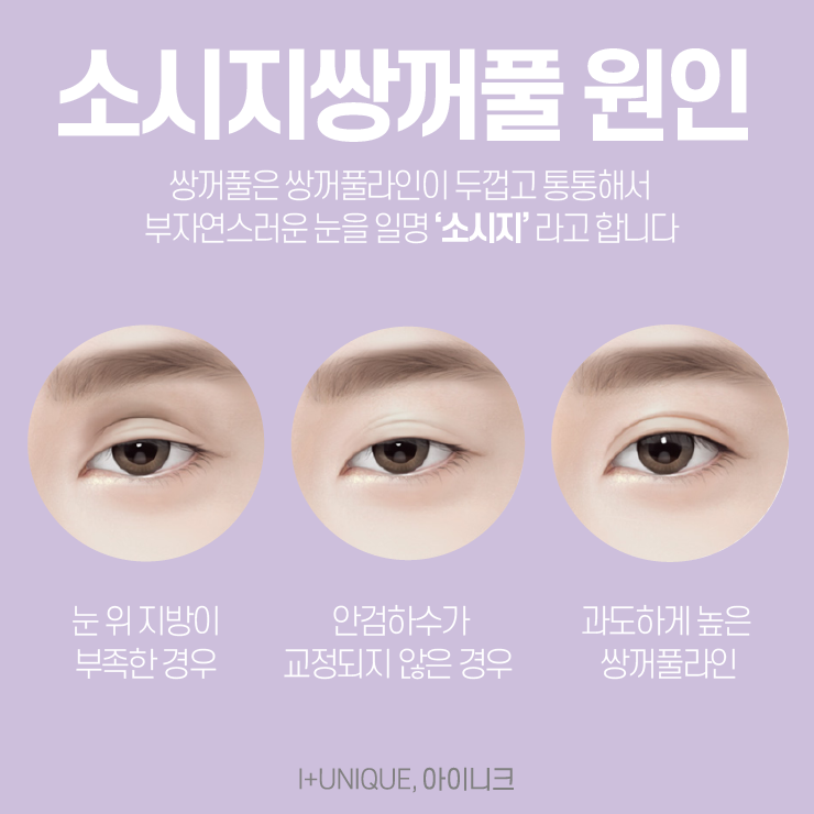 쌍꺼풀재수술잘하는병원, 아이니크성형외과 관련 이미지 2