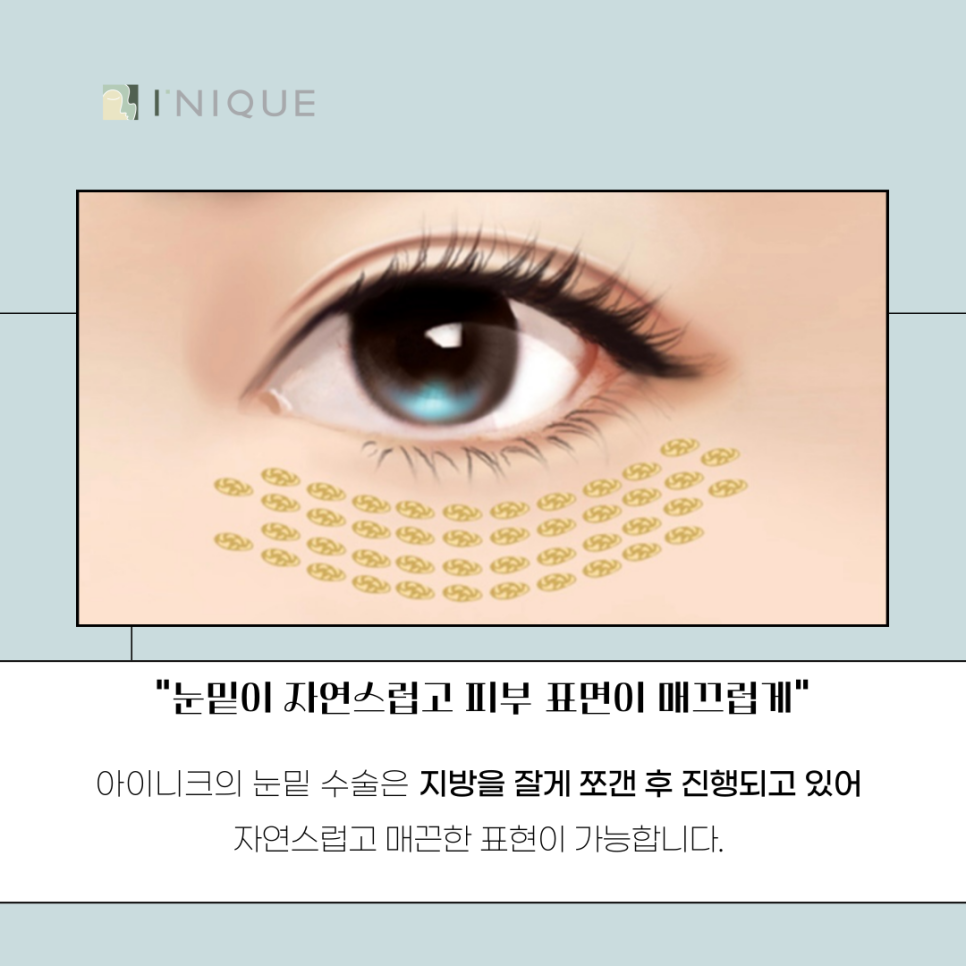 눈밑지방재배치수술후 변화를 기대한다면 관련 이미지 4