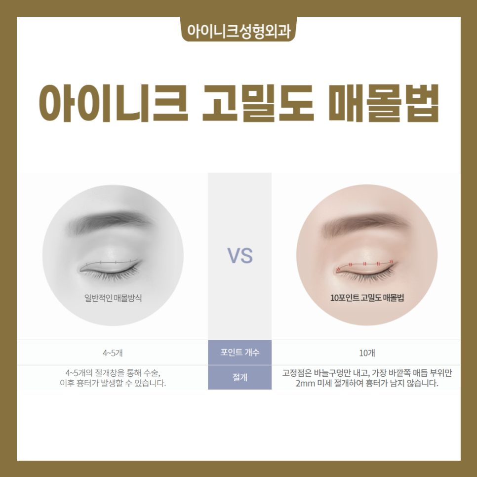 쌍꺼풀 절개법 매몰법 차이점은? 관련 이미지 4