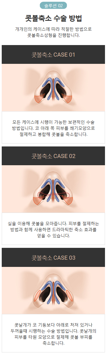 콧방울수술 오밀조밀하고 세련되게 관련 이미지 4