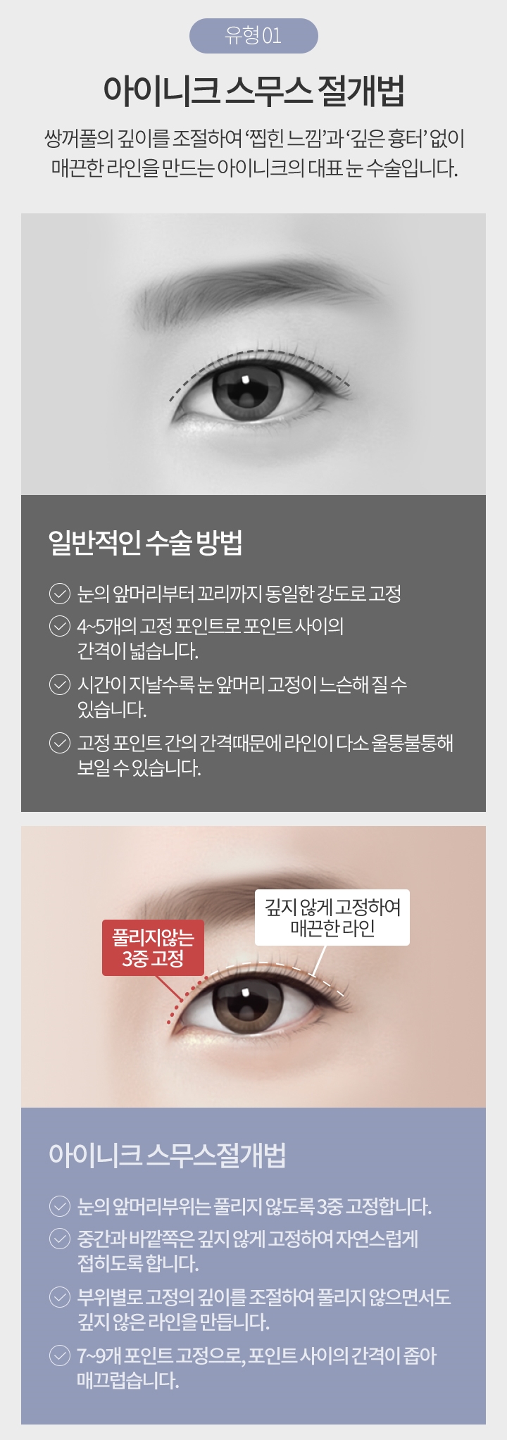 쌍꺼풀절개법전후 비교해보고 결정하세요! 관련 이미지 3